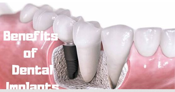 Benifits Of Dental Implants