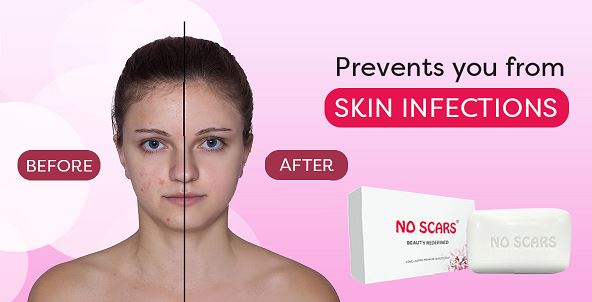 Ensure you are in possession of acne and a spotless skin