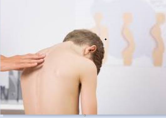 Is Your Child Suffering From Scoliosis