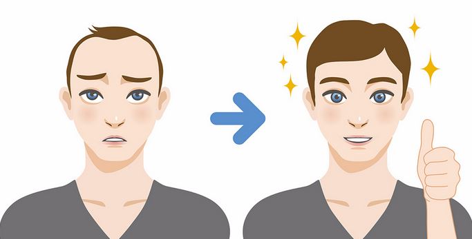 What to expect from hair transplantation treatments