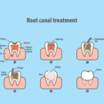 root-canal-treatment-1