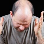 hair loss in men