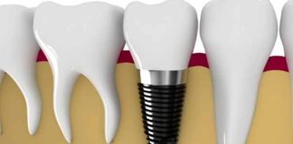 How Much Are Dental Implants for Teenagers? Dental Implants for Teenagers