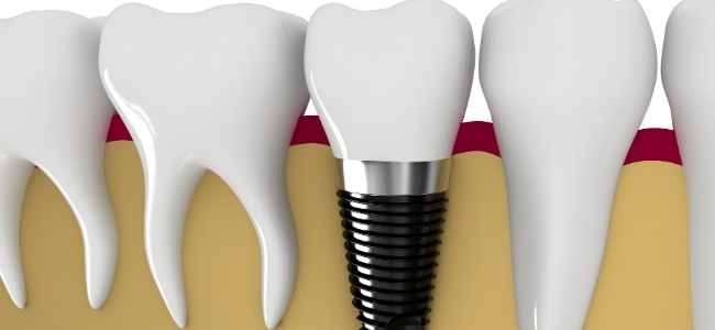 Dental Implants for Teenagers