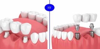 Is Getting a Dental Implant Better Than Getting a Dental Bridge? Is Getting a Dental Implant Better Than Getting a Dental Bridge
