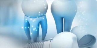 What Are All on 4 Dental Implants? Your Questions, Answered What Are All on 4 Dental Implants