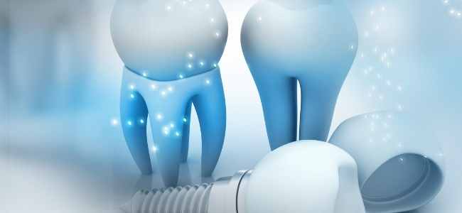 What Are All on 4 Dental Implants