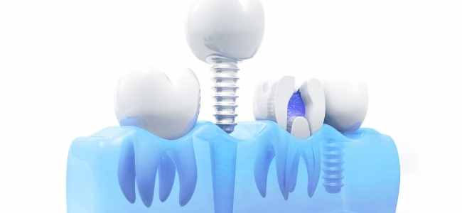 9 Terrific Benefits of Dental Implants