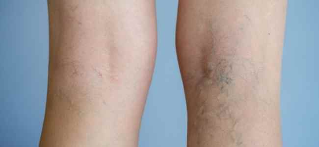 Looking Beyond the Esthetic Value of Treating Varicose Veins by Understanding Their Health Effects