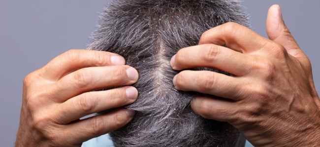 Get Rid of Dandruff With These Tricks
