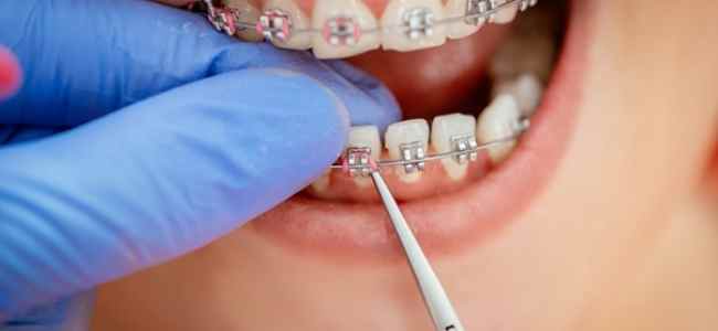 The Health Benefits of Straight Teeth