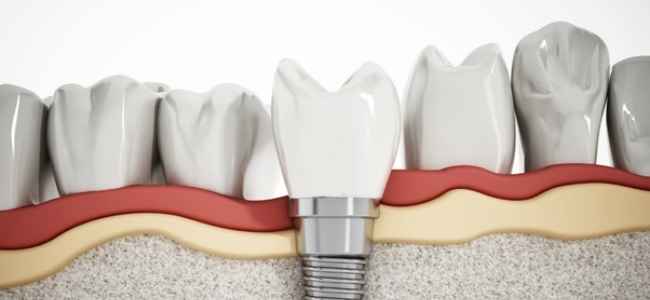 Top 4 Factors to Consider When Picking Dental Implants