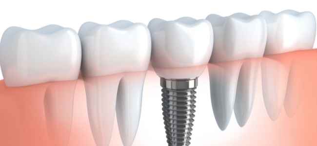 Procedures You Can Receive From An Oral, Maxillofacial & Implant Surgeon