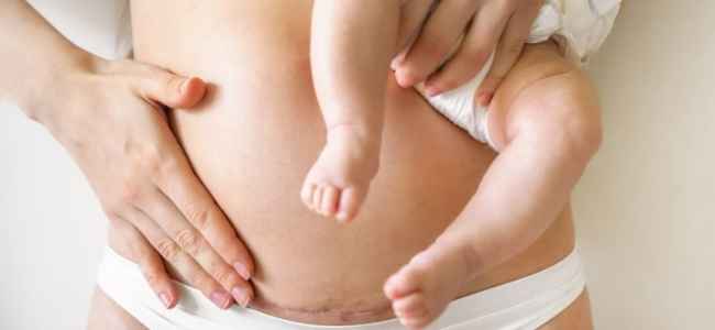 Reduce the Scarring Appearance Due to Cesarean Section with Cosmetic Obstetrics