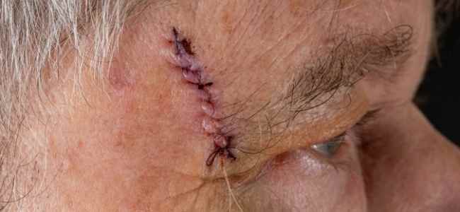 What Are the Benefits of Mohs Surgery