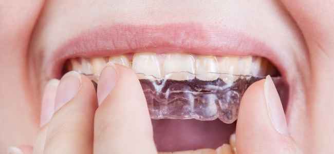 A Guide on the Treatment Process for Clear Aligners and its Benefits