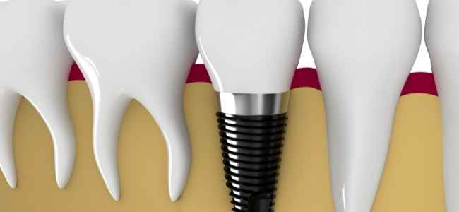 Get Dental Implants