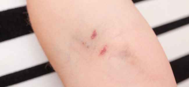 Why Sciton Laser Works Best In Dealing with Chronic Skin Issues