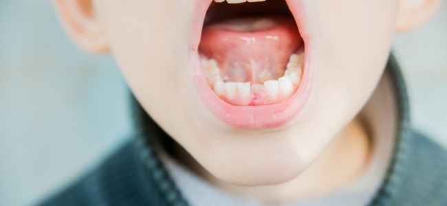 How to Manage Tooth Loss with Dental Bridges