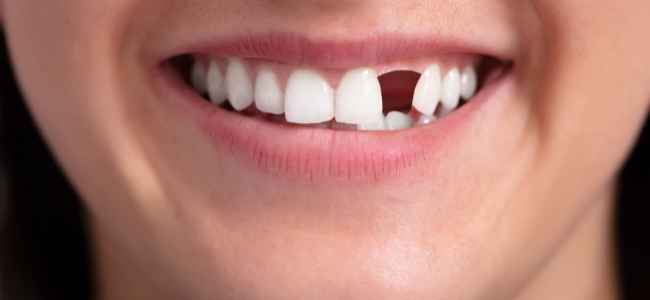 How to Replace Missing Teeth the Easiest Ways