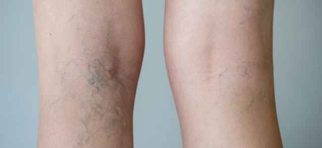 Concerning Signs for Varicose Veins