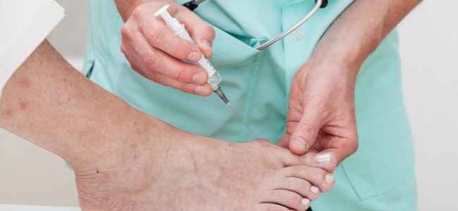 When Do You Need Surgery For Bunion Removal