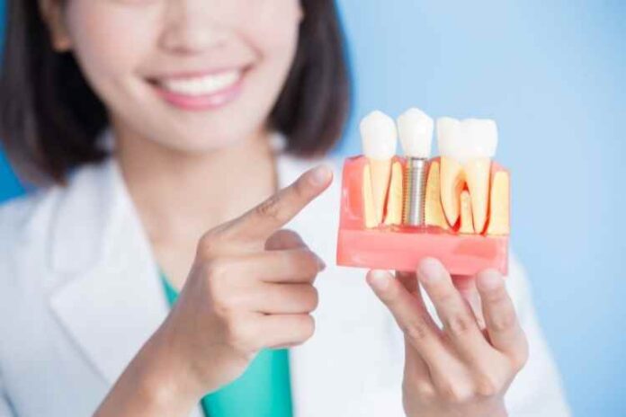 Everything You Need to Know About Dental Implant Restorations