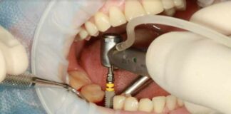 A Complete Guide to the Different Types of Dental Implants A Complete Guide to the Different Types of Dental Implants