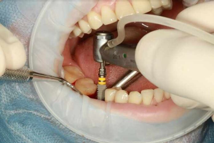 A Complete Guide to the Different Types of Dental Implants