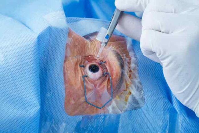 Understanding the Procedure and Recovery of Cataract Surgery