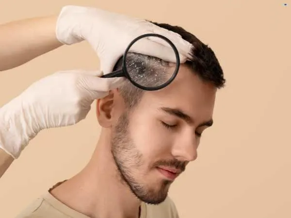 Dandruff Home Remedies